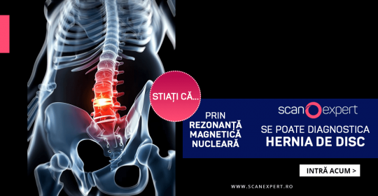 Stiați că … prin rezonanta magnetica nucleara se poate diagnostica hernia de disc
