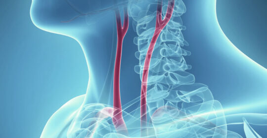 Angiografia RMN la nivelul arterelor carotide, utilă în depistarea stenozelor
